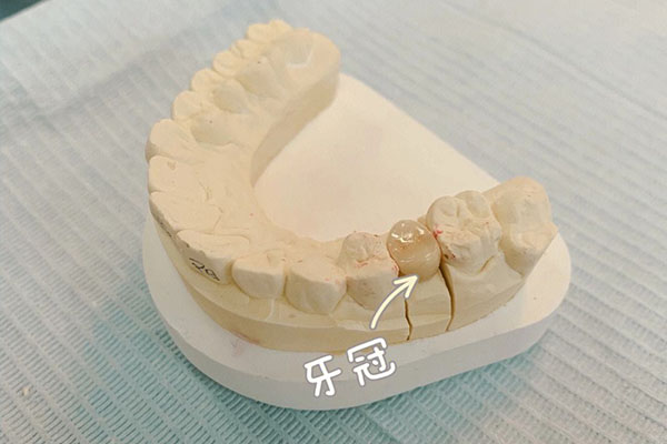 义齿加工厂多少钱一个月工资啊(义齿
