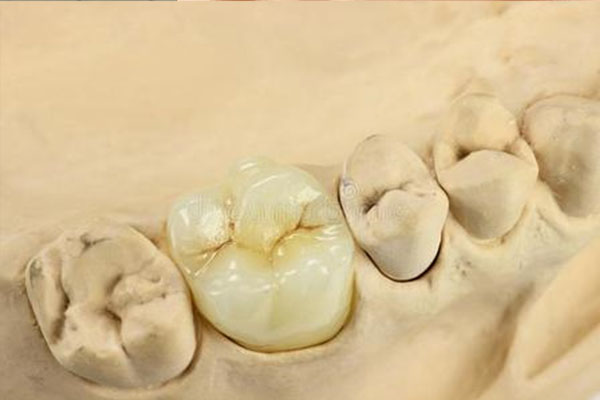 全瓷冠和烤瓷冠的价格一样吗(全瓷冠
