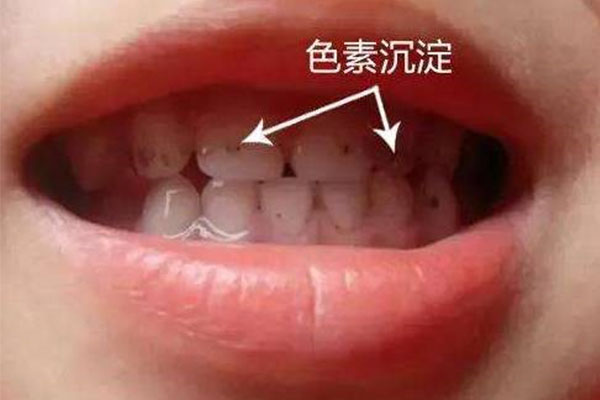 对称性色素异常症怎么改善(对称性色素异常的治疗)