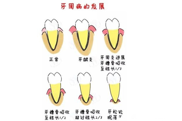 中药治疗牙龈炎牙周炎(中药治疗牙龈