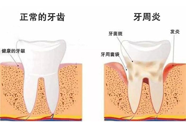 中药冶疗牙周炎有效果吗多少钱(中药冶疗牙周炎有效果吗多少钱