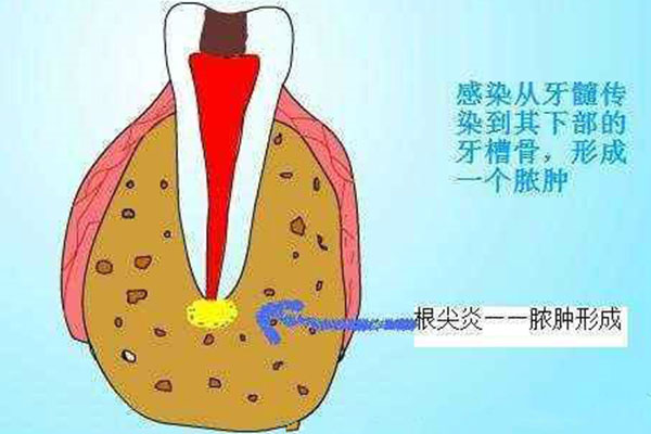 中医治疗牙齿根尖炎怎么治(中医治疗