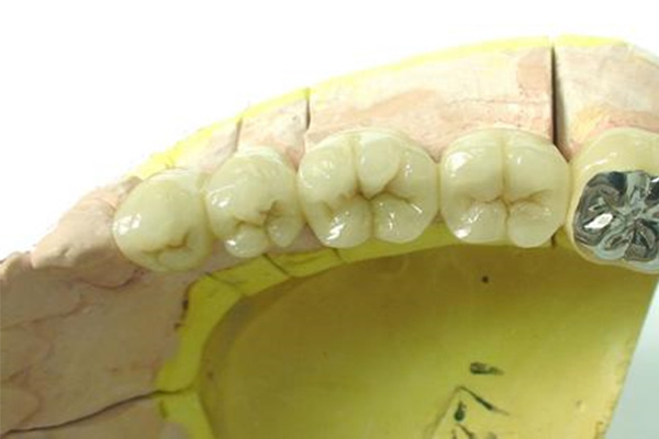 全瓷牙350元一颗(300元1颗的烤瓷牙图片)