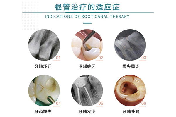 乳牙根管治疗详细步骤(乳牙根管治疗