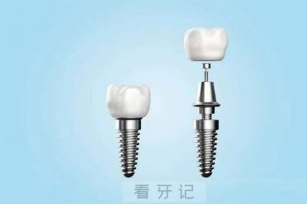 三甲医院种牙收费标准表(三甲医院种牙收费标准表图片)