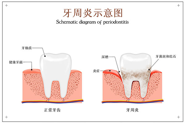 中度牙周炎能变轻度吗能治好吗(中度