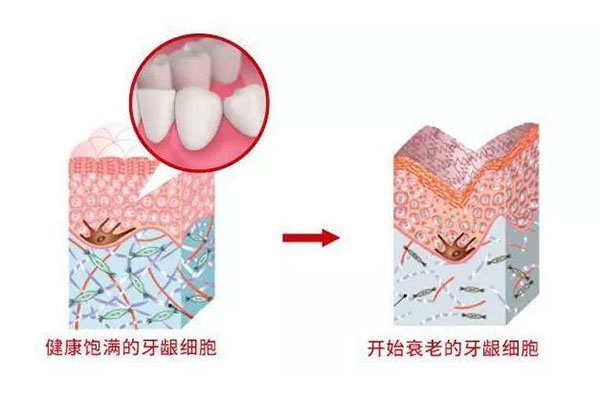 什么保护牙龈萎缩最有效(什么保护牙龈萎缩最有效的方法)