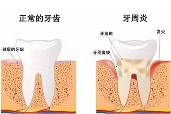什么叫做牙周炎症状(什么叫做牙周炎症状表现)