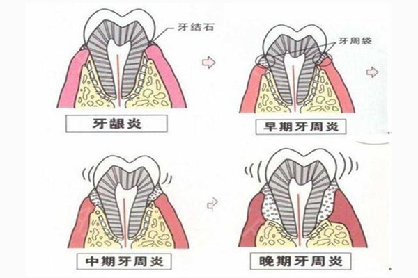 中医牙周炎怎么治疗最有效的药(中医