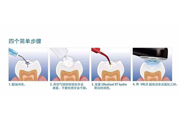 什么叫窝沟封闭治疗牙齿(什么叫窝沟封闭治疗牙齿)