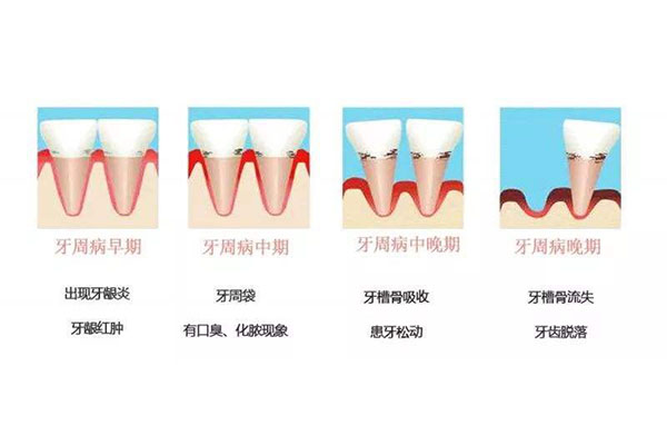 中医牙周炎怎么调理(中医牙周炎怎么