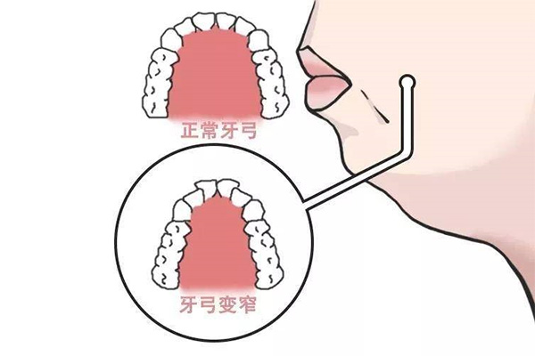什么是慢性智齿冠周炎