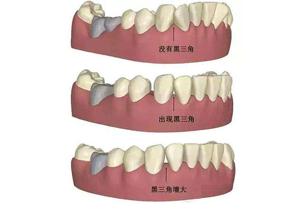 什么原因会导致牙龈萎缩症状