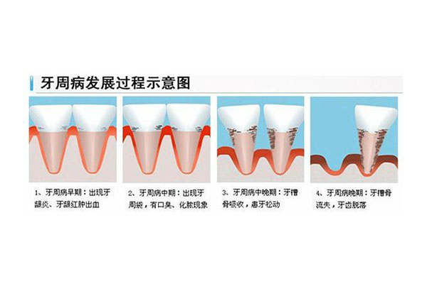 中医解释牙周炎的病因是什么引起的(中医牙周炎是什么原因引起