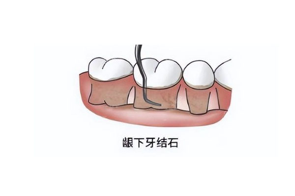 洁牙后多久可以喝冷水(洁牙后多久可以喝冷水喝热水)