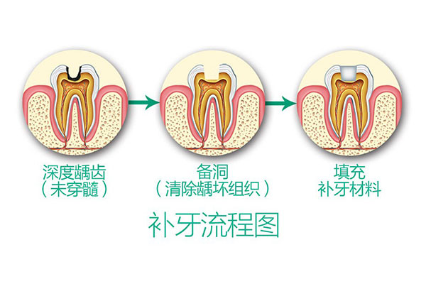 上海补颗牙齿要多少钱(上海补颗牙齿