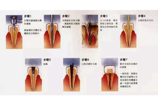 做个烤瓷牙要多少钱一颗(做个烤瓷牙要多少钱一颗呀)