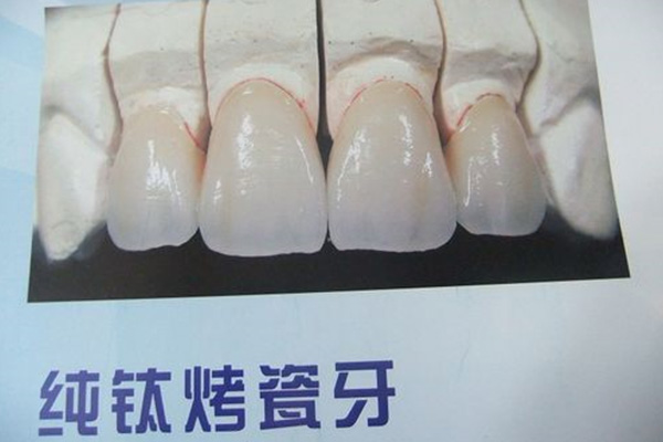 在医院镶牙医保报销吗多少钱一颗(在