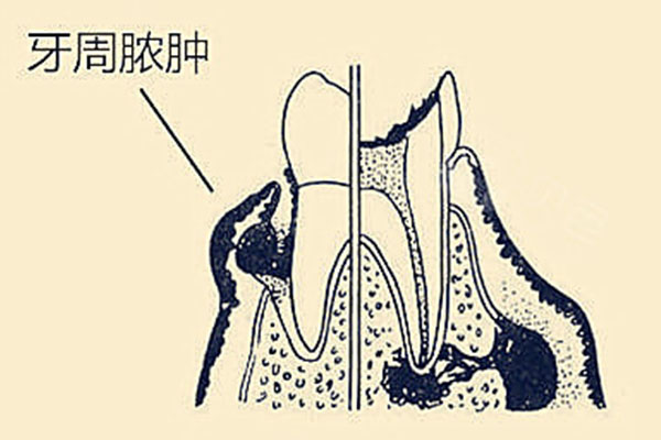 中医牙周炎怎么治疗最有效(中医牙周炎怎么治疗最有效的方法