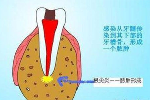 儿童根尖周炎怎么办(儿童根尖周炎会