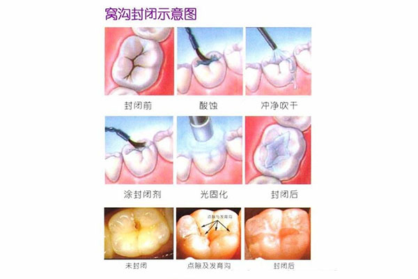 做一次牙齿窝沟封闭多少钱(做一次牙齿窝沟封闭多少钱一颗)