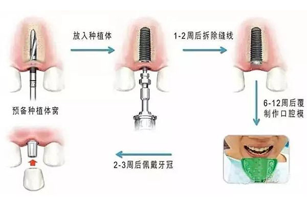 上海种牙齿可以用医保报销吗多少钱(上海种牙齿可以用医保报销
