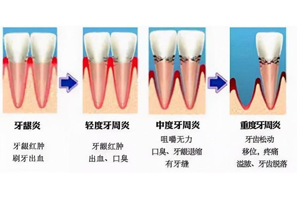 中度牙周炎刮治后会变轻度吗(中度牙周炎刮治后会变轻度吗)