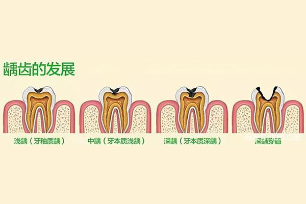 2周岁宝宝蛀牙(2周岁宝宝蛀牙有洞)
