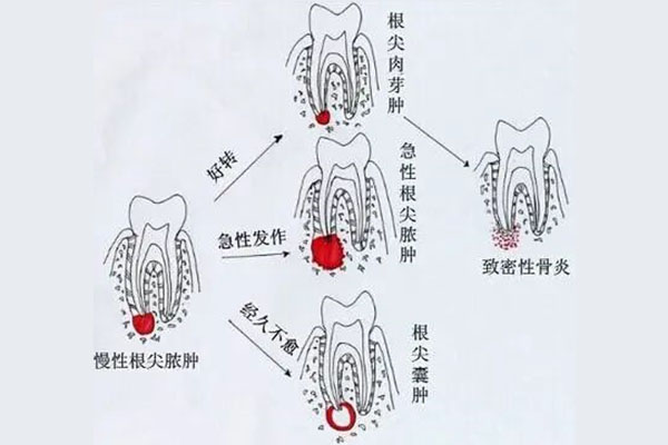 儿童根尖炎治疗后下面牙齿也痛(儿童