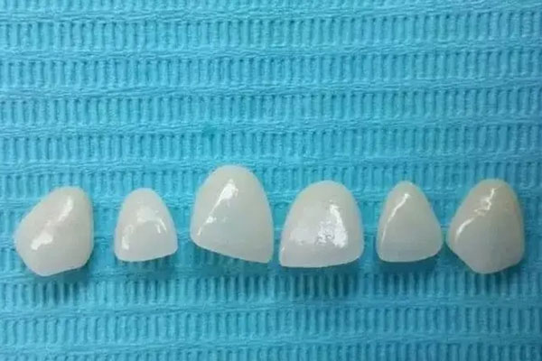 冷光美白和牙齿贴面哪个好用(冷光美白和牙齿贴面哪个好用点