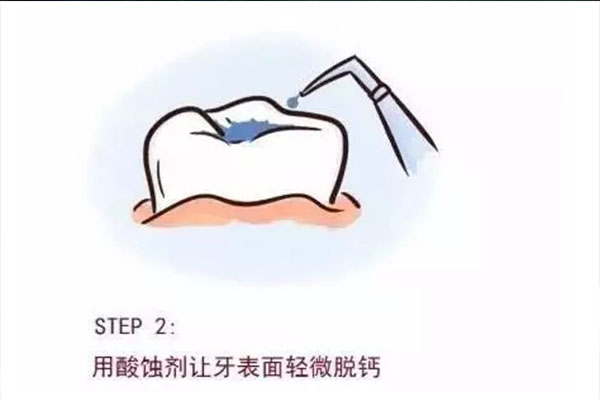 上海儿童医院 窝沟封闭(上海儿童医学中心 窝沟封闭)