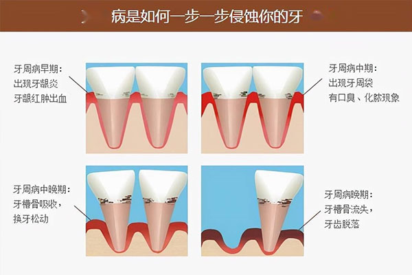 什么病会引起牙周炎症状(什么病会引
