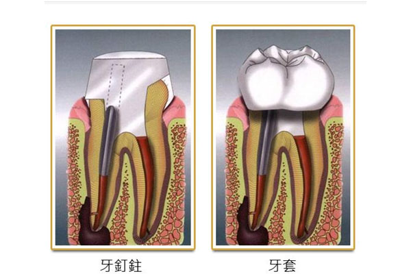 儿童牙根尖周炎吃什么药效果好(儿童牙根尖周炎吃什么药效果好