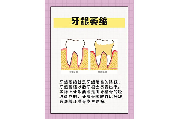 中医治疗牙龈萎缩牙根外露的方子(中医治疗牙龈萎缩牙根外露的