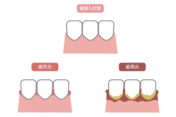中度牙周炎最简单处理方法(中度牙周炎最简单处理方法是什么
