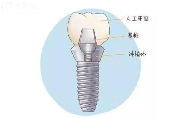 上海种牙可以进医保吗(上海种牙可以进医保吗现在)