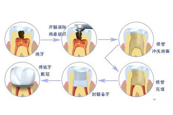 上门牙补牙比较容易掉吗(上门牙补牙比较容易掉吗)