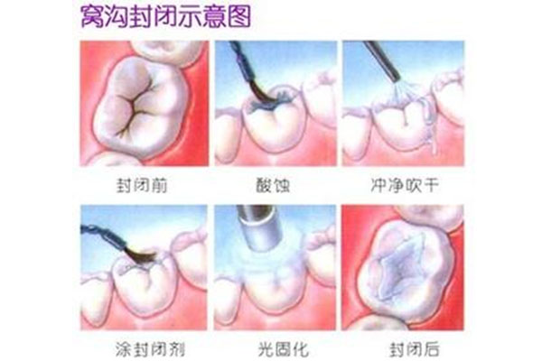 什么叫封窝沟封闭(什么叫封窝沟封闭