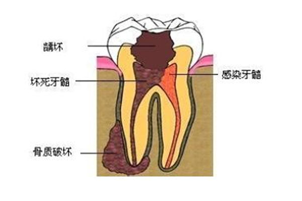 4岁孩子有龋齿怎么办(4岁孩子有龋齿怎么办呀)