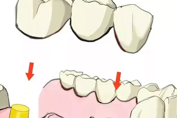 做烤瓷牙和补牙的治疗方法一样吗(做烤瓷牙和补牙的治疗方法一