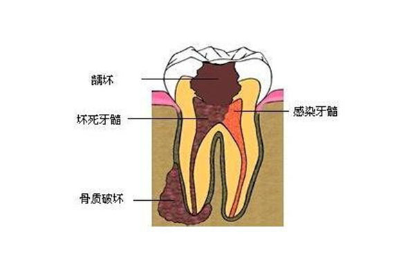 3岁宝宝虫牙疼怎么办 立刻止疼(三岁宝宝虫牙疼的厉害怎么办
