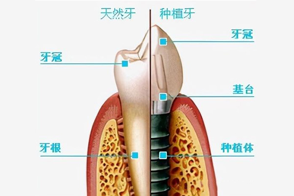 上长春种牙哪家好一点的医院(上长春种牙哪家好一点的医院)