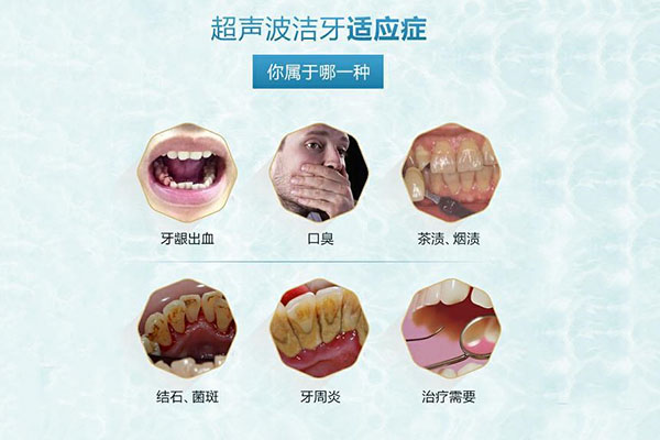 公立医院洗牙的价格是多少(公立医院
