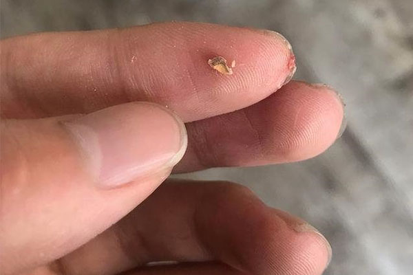 牙齿缺损一大块是否该保留(牙齿缺损