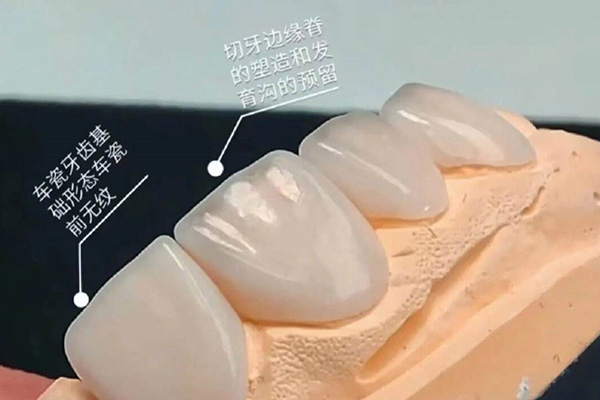 全瓷牙贴面多少钱一颗牙(全瓷牙贴面