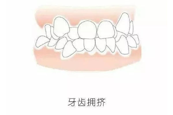 牙齿拥挤怎么矫正比较好呢女生(牙齿