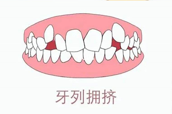 牙齿拥挤的危害(牙齿拥挤的危害图片