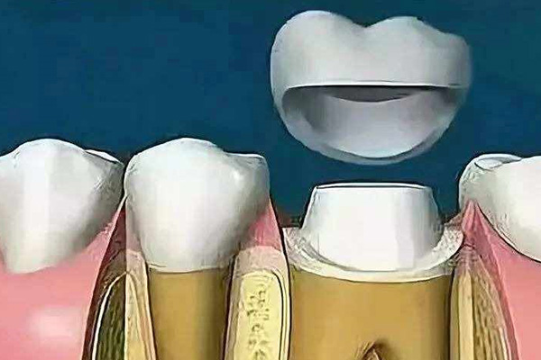 临时补牙材料能用多久(自己网上买的