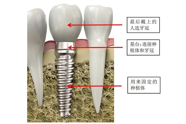 上海种牙齿可以用医保报销吗多少钱一颗(上海种牙能报销吗)