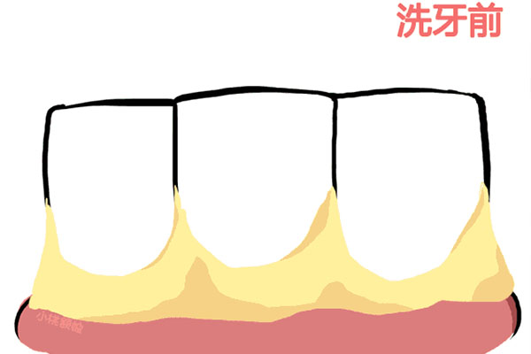 儿童换的新牙齿怎么变黄了(儿童新换